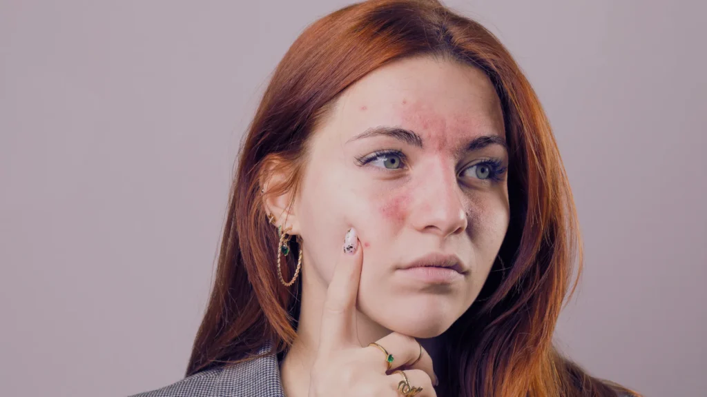 Tratamientos para rojeces faciales en San Fernando, Cádiz