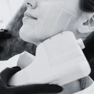 HIFU Facial